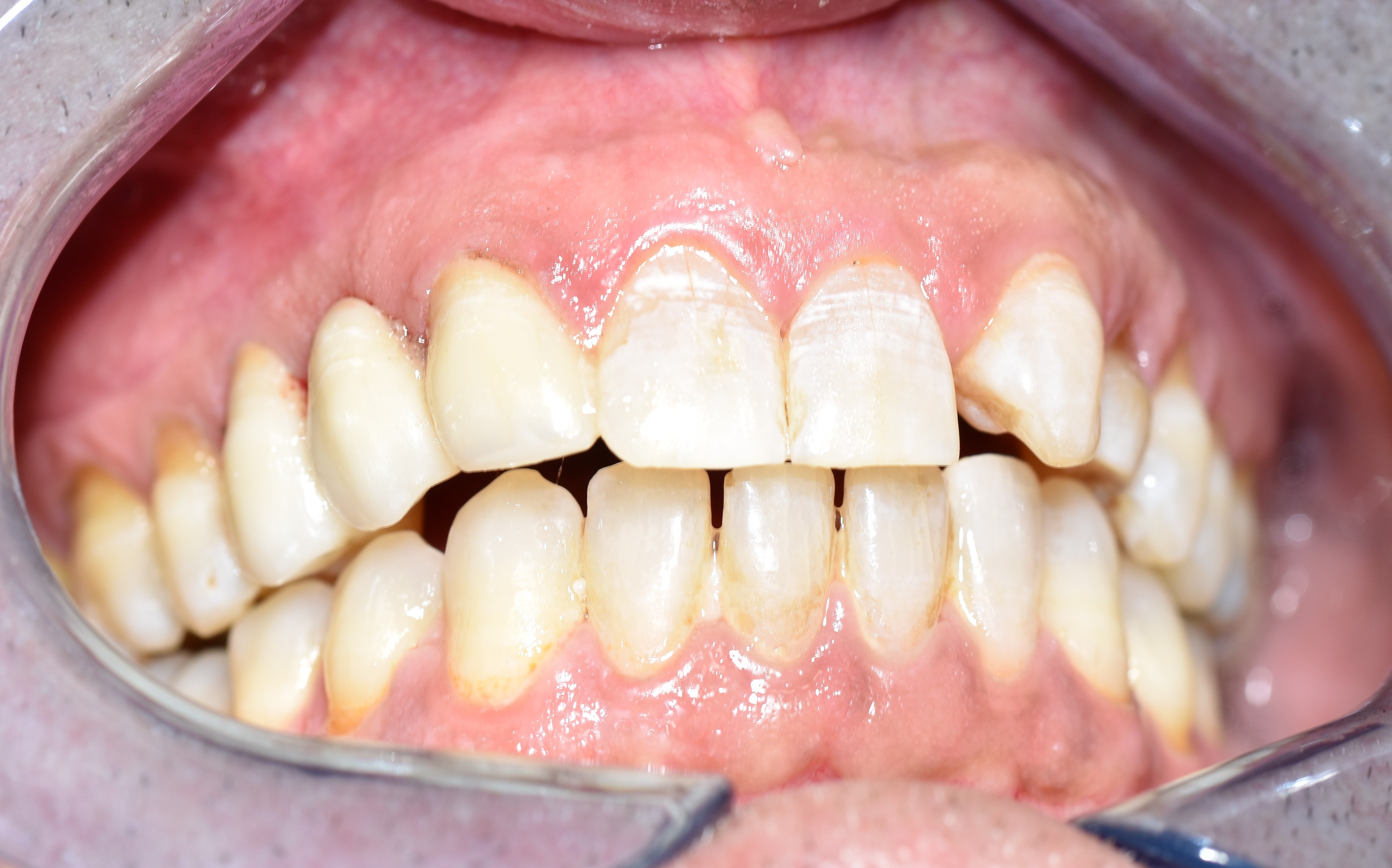 After treatment